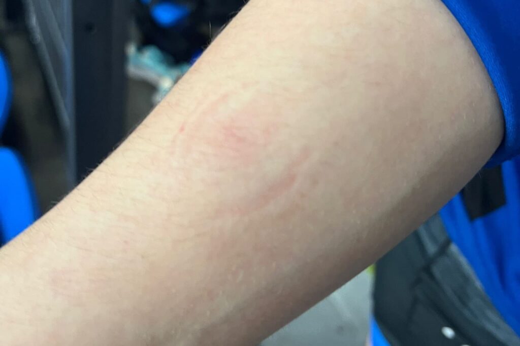 Sara Rantonen käsi purema Tallinna Open 2026